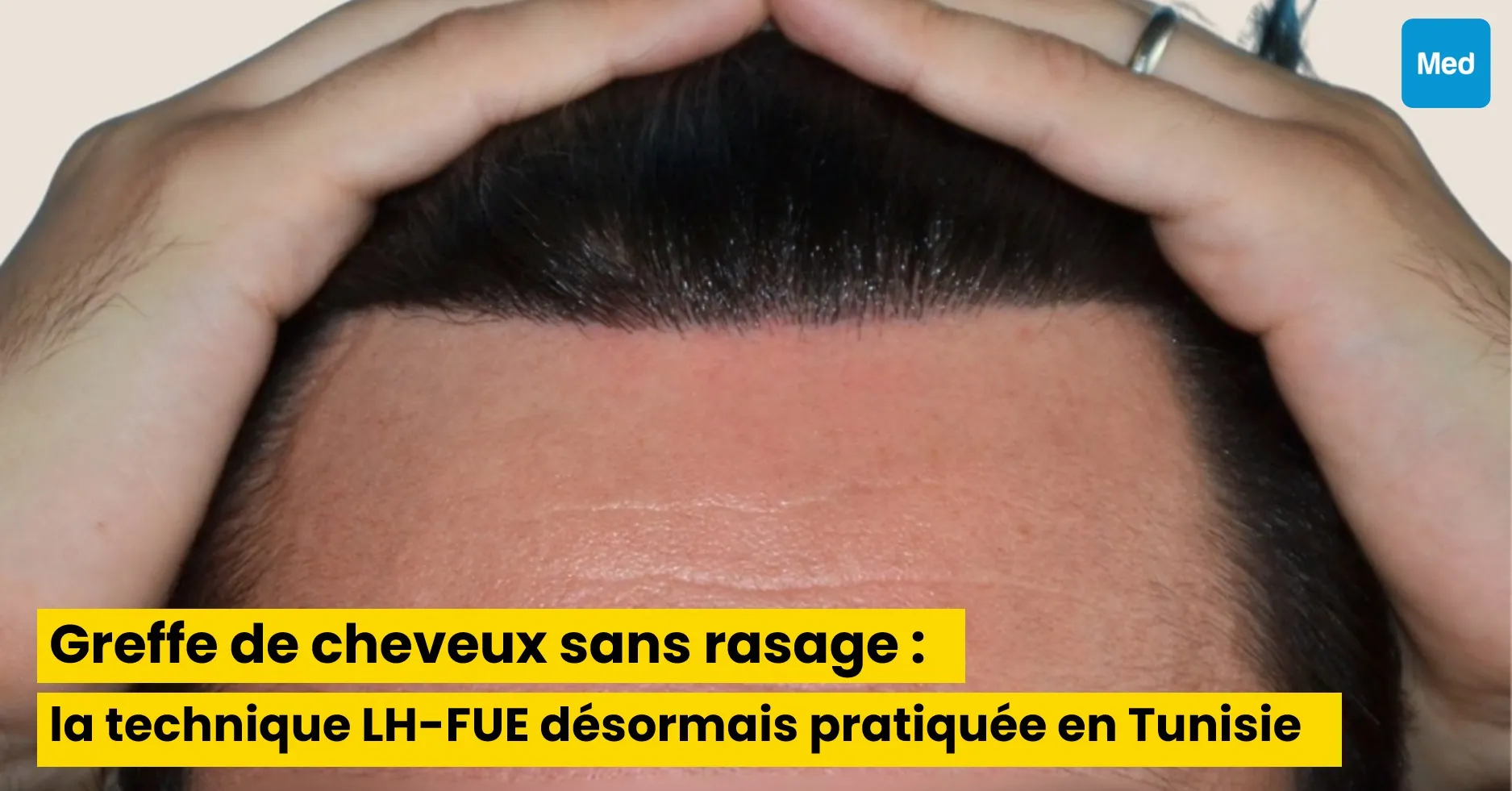 Greffe de cheveux sans rasage : la technique LH-FUE désormais pratiquée en Tunisie